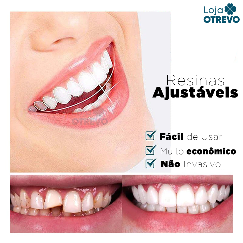 SmileFit® - Facetas Dentárias Naturais Removíveis