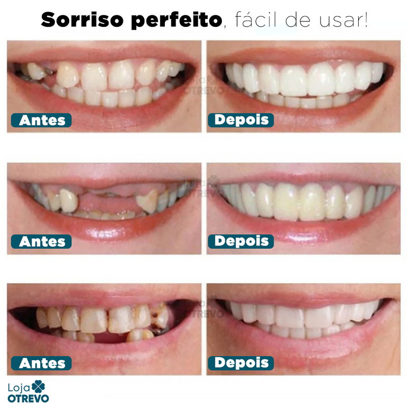 SmileFit® - Facetas Dentárias Naturais Removíveis