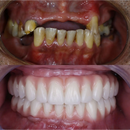 Dentadura de Silicone FIX | Ajustavel e Adaptativa